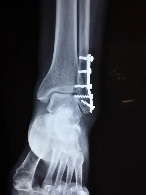 Trump’s Health: Chronic Venous Insufficiency & TikTok Rumors